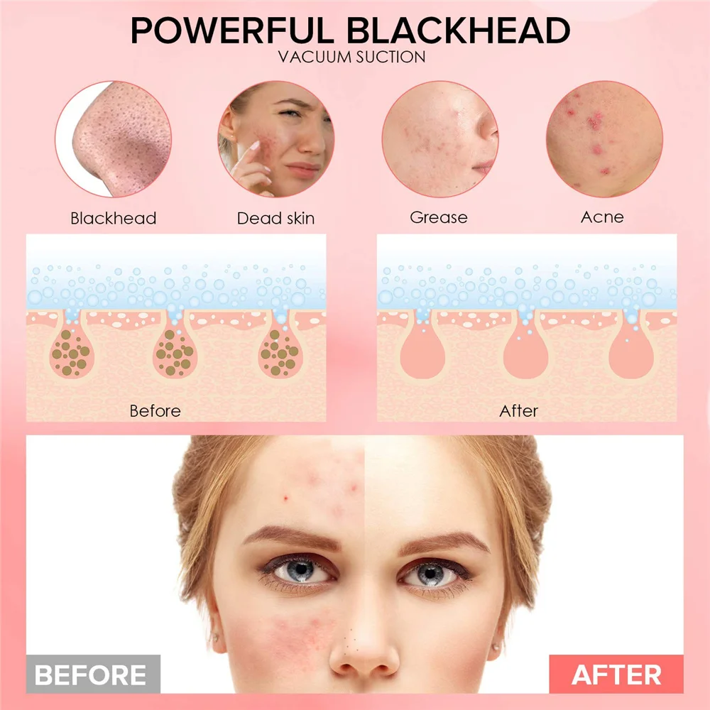 Blackhead как пользоваться