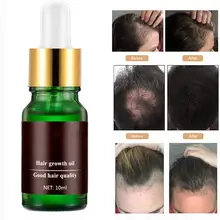 10 мл Для женщин Для мужчин имбирь роста волос сыворотки противодействие головы лечения Для мужчин t эфирное масло