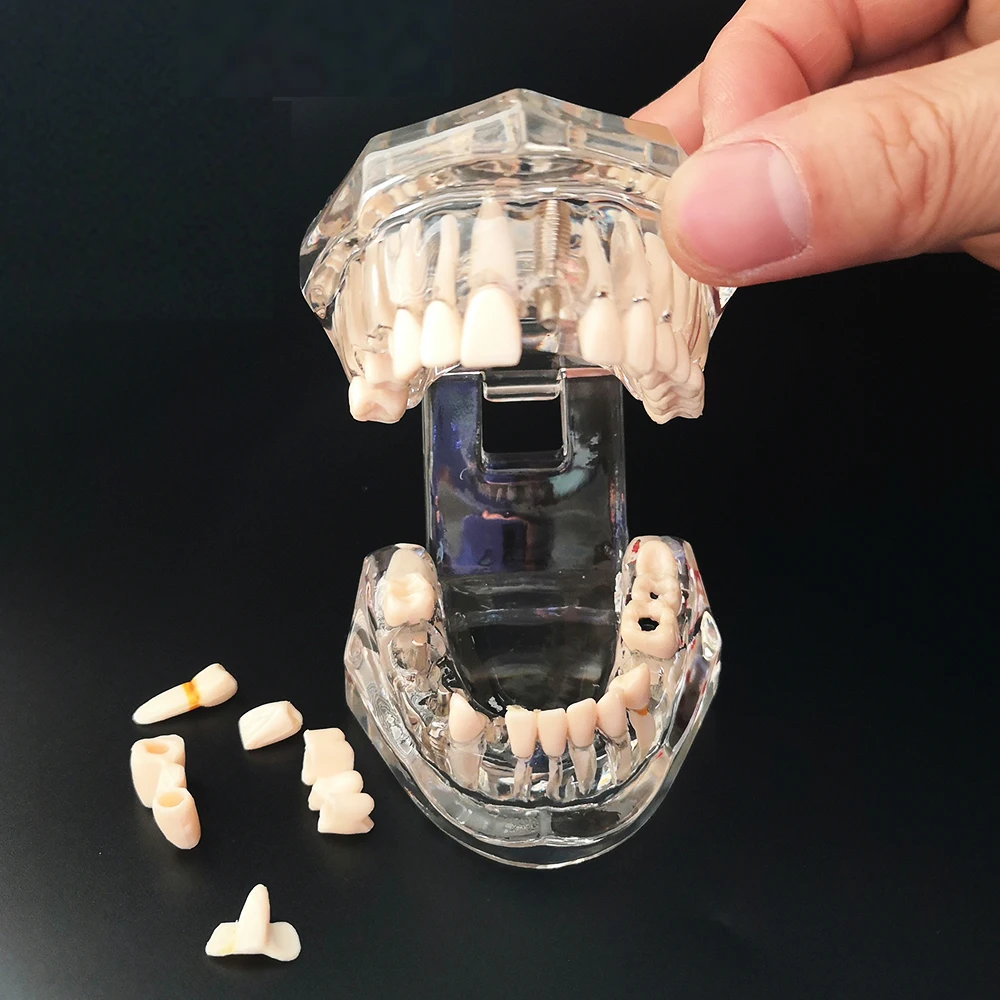 Зубная модель зубной имплантат с реставрационным мостом стоматолог медицинская