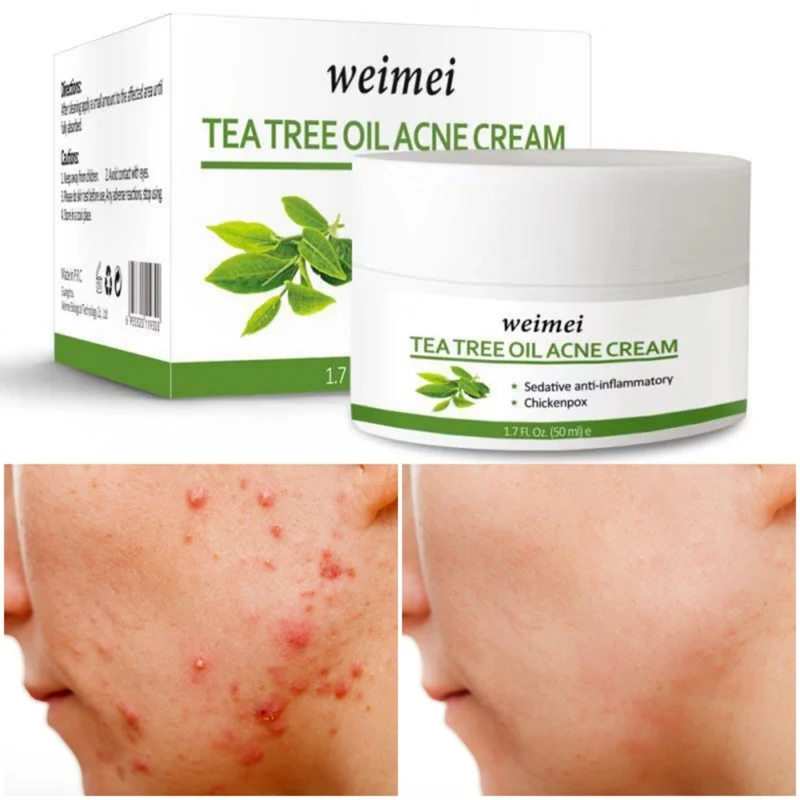 

50ml Tea Tree Essence Acne Treatment Cream Moisturizing Nourishing Skin Oil-Control Remove Blackheads Pimples Anti-acne Cream