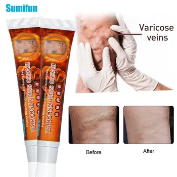 

2pcs Sumifun Varicose Veins Ointment Treatment Vasculitis Phlebitis Spider Leg Chinese Medical Plaster Varicosity Angiitis Cream