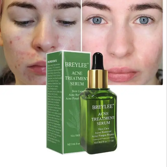 Эссенция для лица против рубцов от акне крем ухода за кожей отбеливающий ремонт