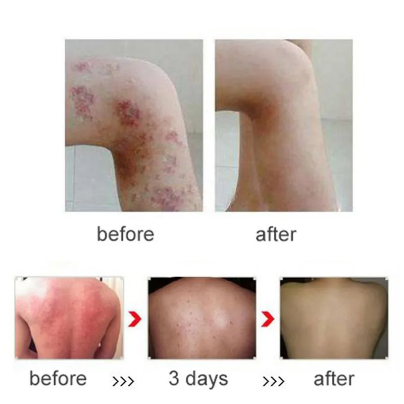 

Hotsale Chinese herbal skin topical antipruritic ointment cream Analgesic Balm Ointment Psoriasis Cream Body Massage Patches