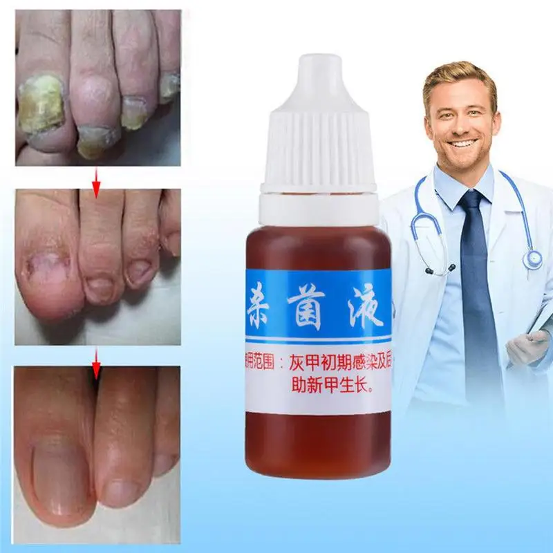 10 мл Здоровье Уход за кожей ногтей ремонт жидкое моющее средство для снятия онихомикоза