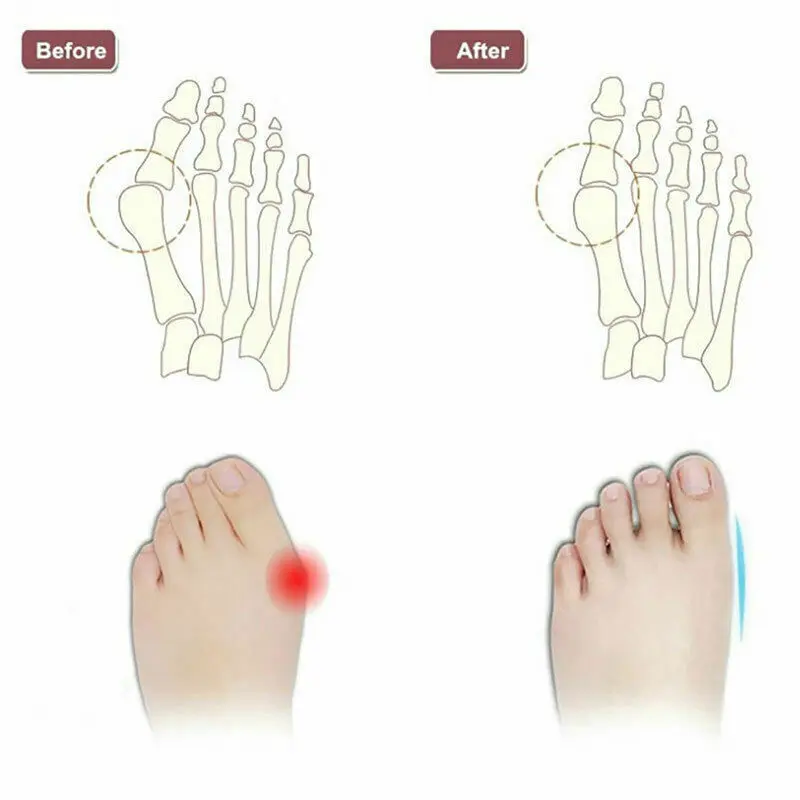 1 Pair Five-hole Toe Pads Silicone Elastic Toe Corrector Straighteners Eversion Overlapping Toe Correction Pads TSLM1