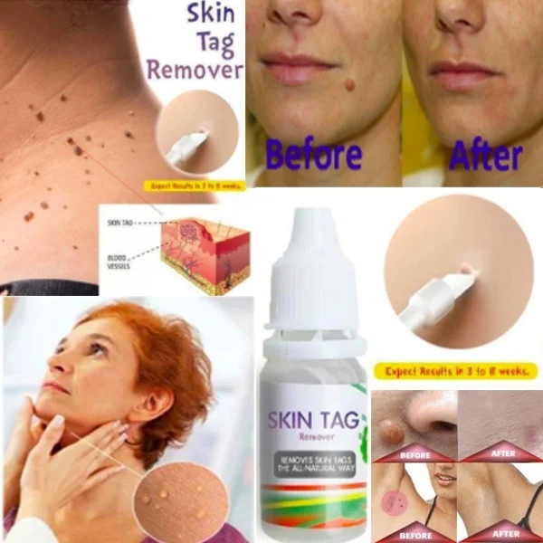 

Skin Tag Remover 12 hours Tu kill Medical Tu kill Remover Skin Tag Mole & Genital Wart Remover Foot Corn Removal