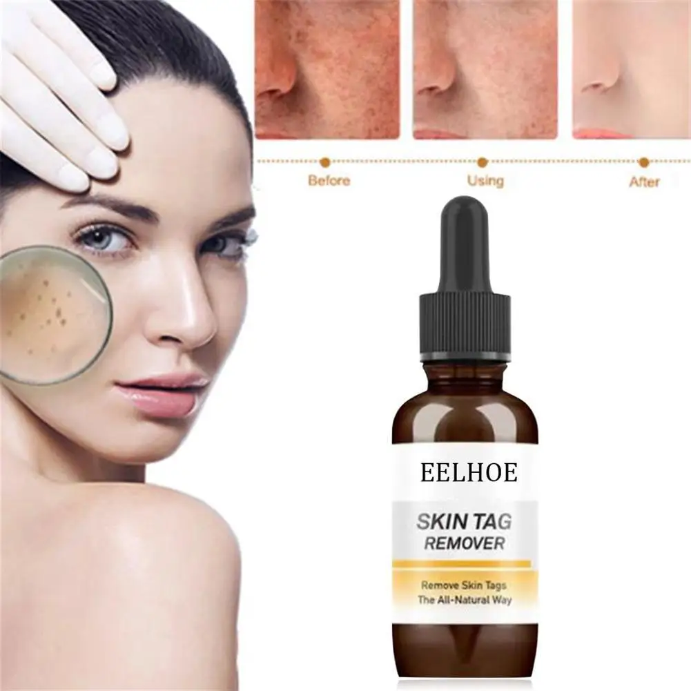 

Mole & Skin Tag Removal Solution Painless Mole Skin Dark Face Tag Removal Spot Oil Freckle Wart Cream Removal O6R4