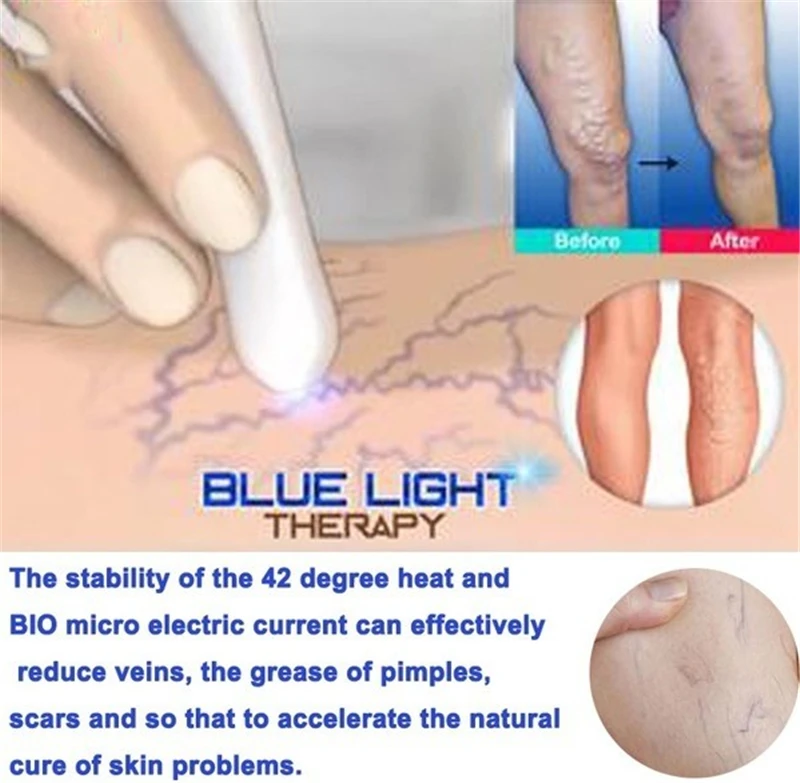 Синий светильник, лазерная ручка для лечения акне, удаление пятен и морщин, устройство для ухода за кожей, оборудование для красоты