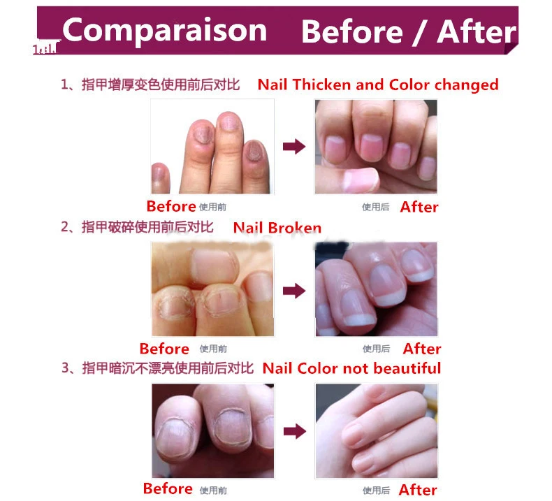 Fungal_Nail_Feet_Care_Essence_Nail_Foot_Whitening_Toe_Nail_Fungus_Removal_Gel_Anti_Infection_Paronyc (5)