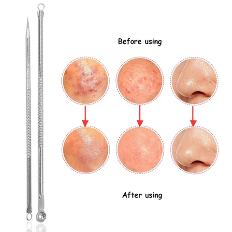 Acne Needle Tweezers Face Care Blackhead And Pimple Remover Comedone Acne Extractor Point Clean Black Head Remover Tool