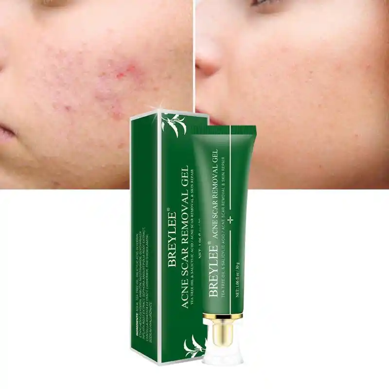 acne scar pigmentation products