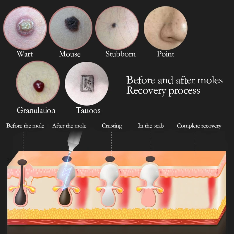 Новые технологии оборудование для красоты/лазерная ручка удаления пятен красота