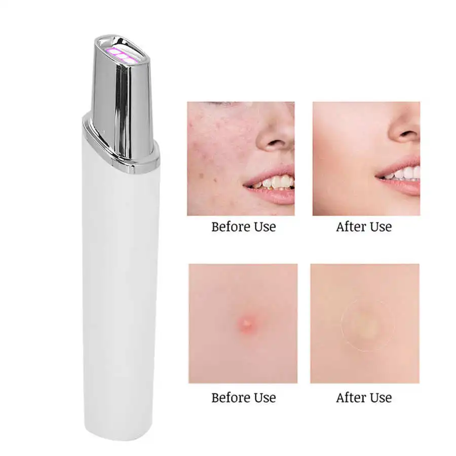 Acne Removal Device Portable Acne Laser Pen Electric Red Blue Light