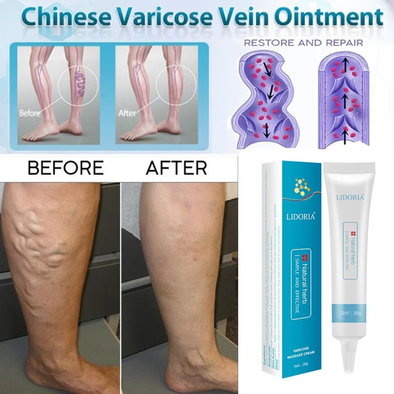 Varicose Veins Cream Promote Blood Circulation Relief Phlebitis Vasculitis Treatment Ointment Vessel Care |