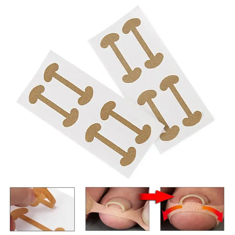 Ingrown Toe foot Nail Correction Fixer Pedicure Tool Toenail Corrector. | Красота и здоровье