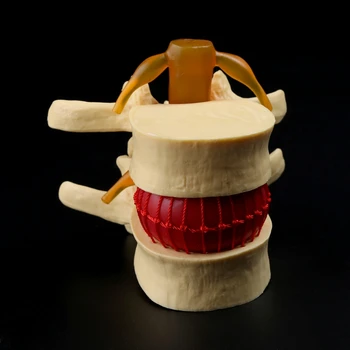 

Anatomical Spine Lumbar Disc Herniation Anatomy Medical Teaching Tool
