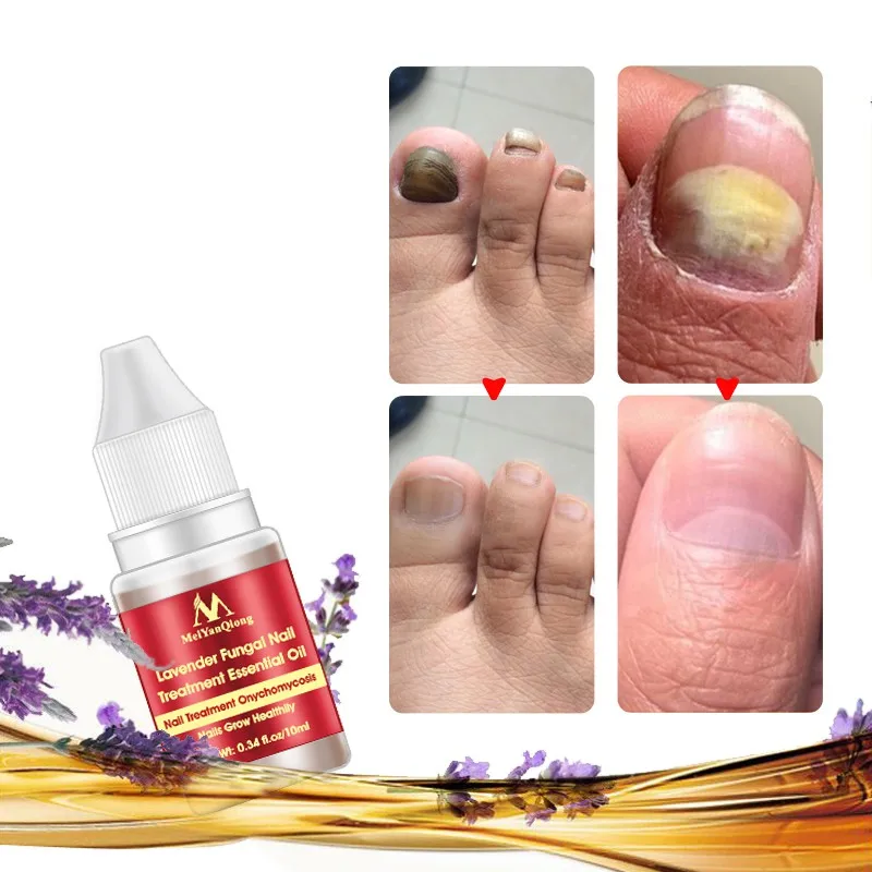 Лаванда грибковое Лечение ногтей эфирное масло Paronychia onychomicosis защита для ремонта ногтей