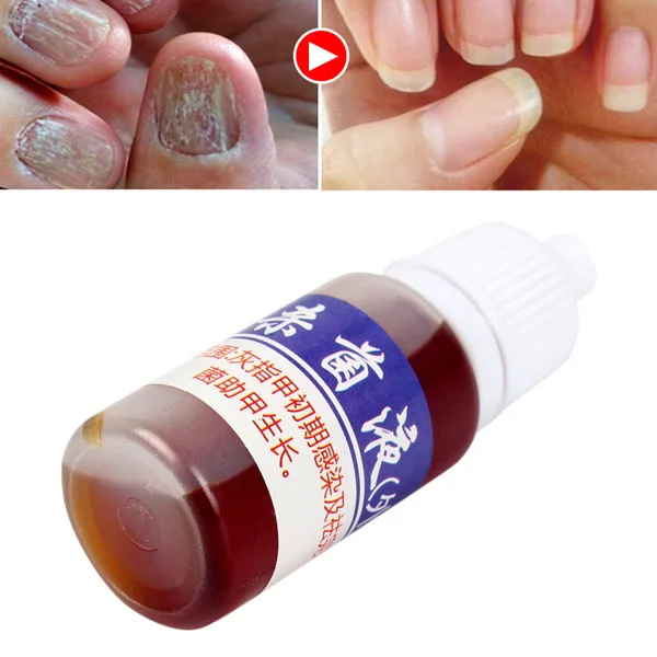 Жидкость для лечения Ногтей питает противогрибковые ногти инфекция китайские травы жидкость 998