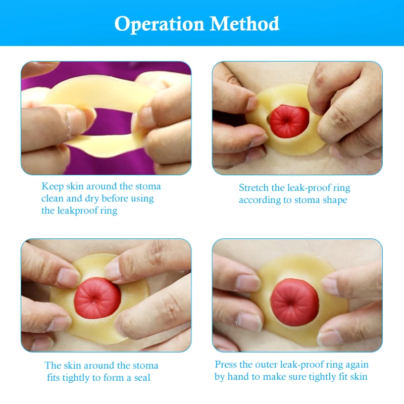 colostomy barrier ring