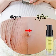 Eliminación de acné y cicatrices estrías crema cicatrices estrías gravídaras tratamiento seguro sin efectos secundarios Reparación de tejido necrótico Stre(China)