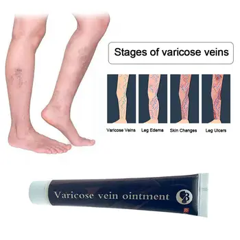 

Varicose Veins Treatment Cream Effective Health Care Ointment Varicose Veins Cure Patch Vasculitis Natural Solution Herbal