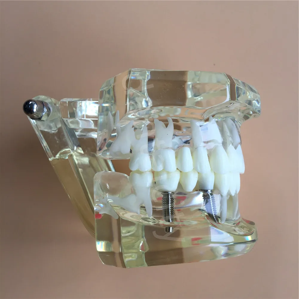 Новая модель зубного импланта с реставрационным мостом для протеза|teeth model|dental