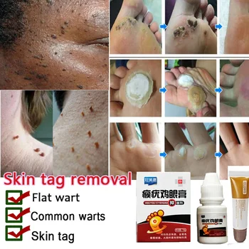 

10ml Skin Tag Remover Bacteriostatic Liquid Medical Genital Wart Treatment Foot Corn Repair Essence Moles Fast Removal Set