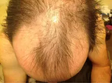 Cuidado del cabello para el crecimiento del cabello aceites esenciales esencia Original auténtico 100% pérdida de cabello líquido salud belleza suero denso para el crecimiento del cabello