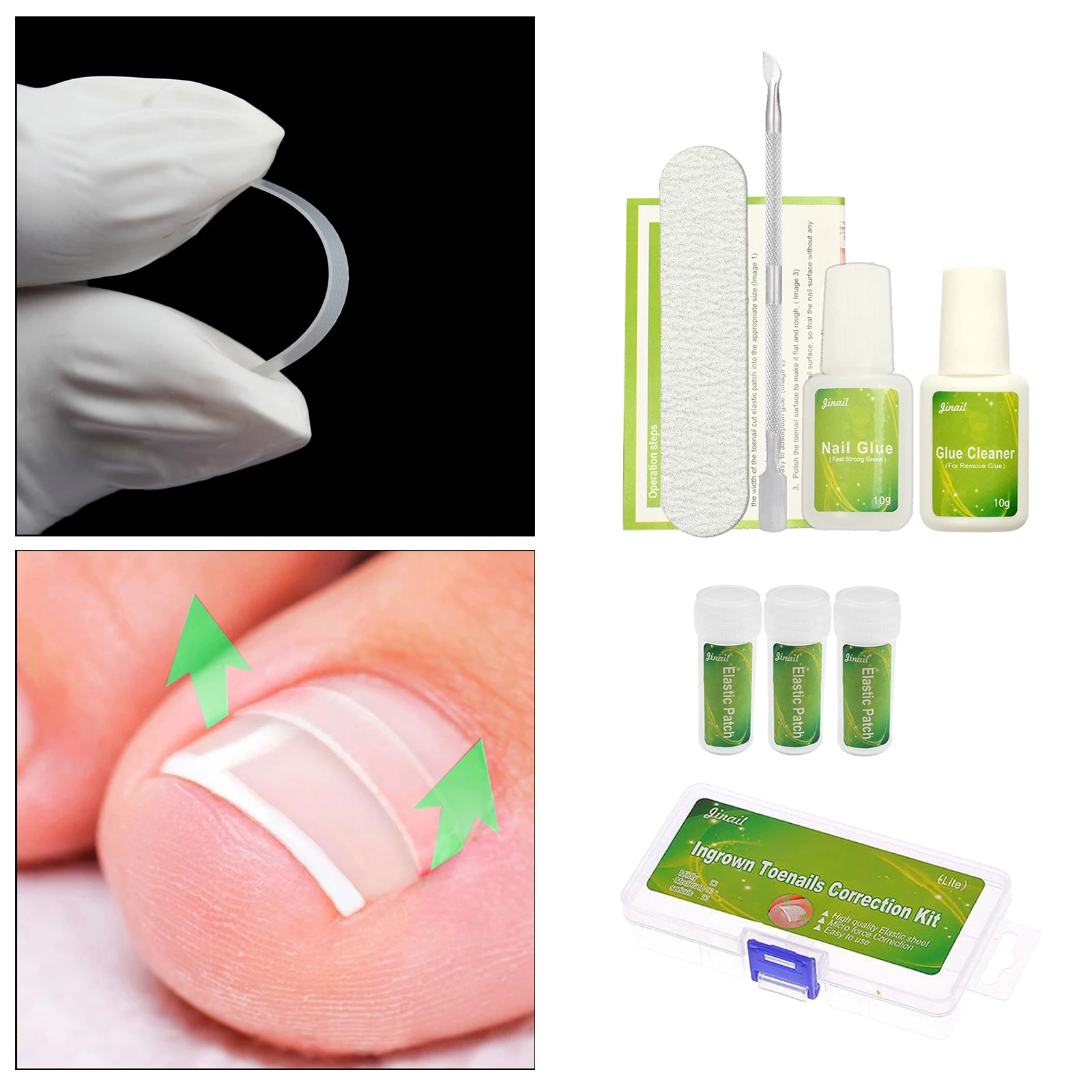 Ingrown Toenail Correction Tool Toenail Treatment Corrector Stickers W/ Glue