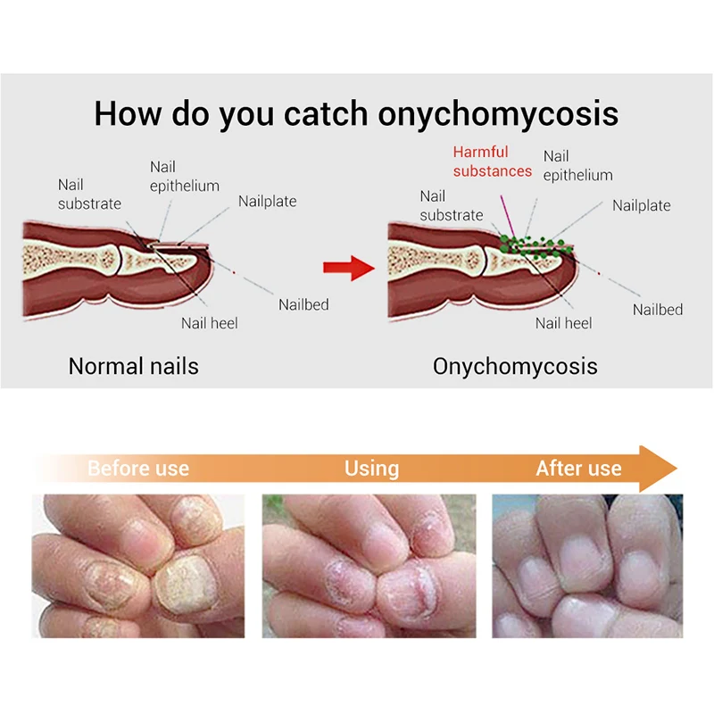 New 12ml Nail Fungal Treatment With File Anti Fungus Onychomycosis Removal Nails Care Repair Liquid
