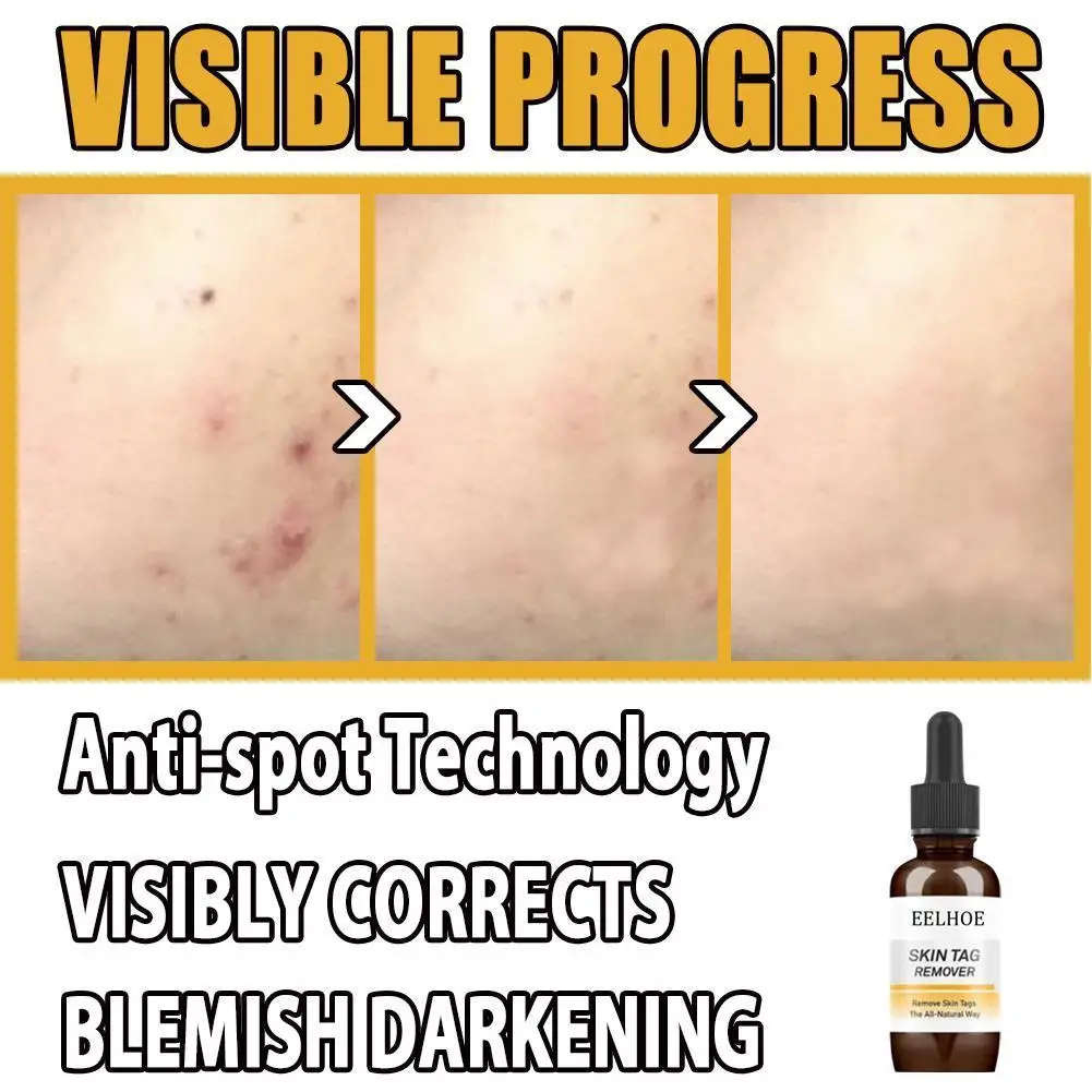 

Mole & Skin Tag Removal Solution Painless Mole Skin Spot Removal Cream Face Dark Wart Oil Tag Freckle Removal J7P9