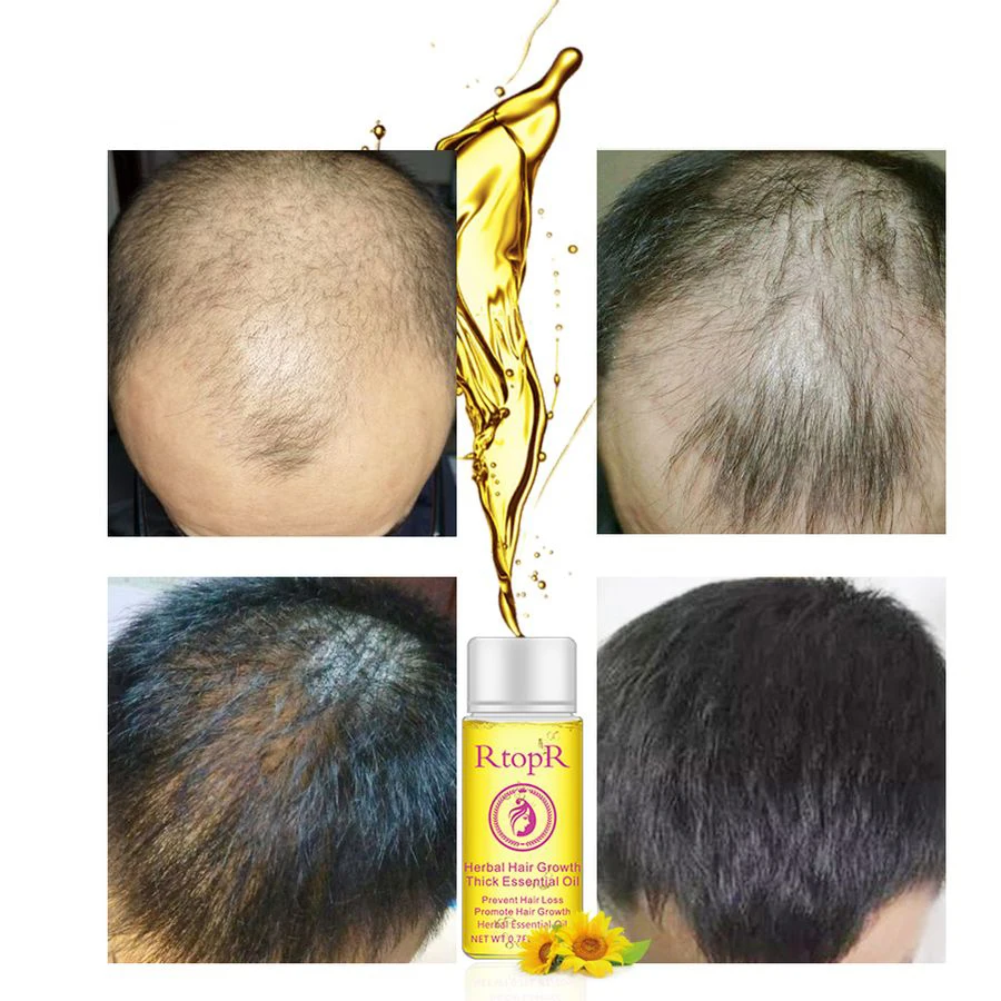 

Hair Growth Essential Oil Hair Loss Liquid Promote Thick Fast Anti Hair Growth Treatment Health Care Massage Essence Oil