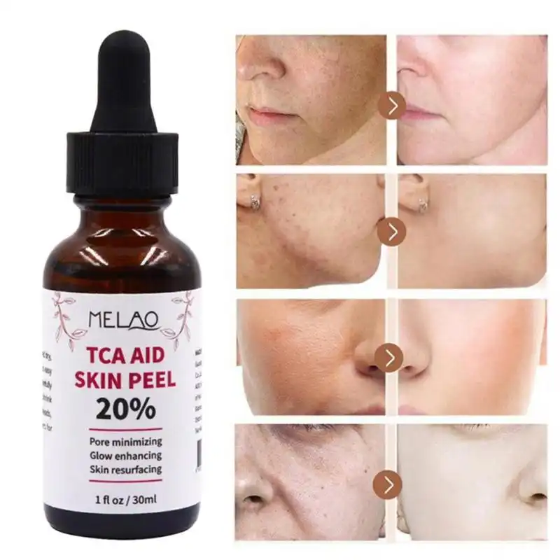 tca skin care peels