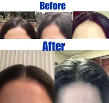 Cuidado del cabello para el crecimiento del cabello aceites esenciales esencia Original auténtico 100% pérdida de cabello líquido salud belleza suero denso para el crecimiento del cabello