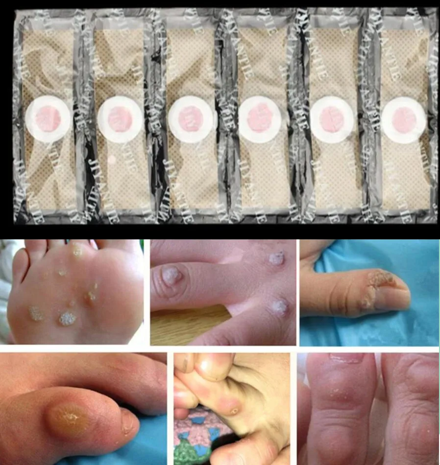 Sticker Patch Corn-Removal-Pads Detox Foot-Plaster Warts Health-Care Curative 60pcs Thorn
