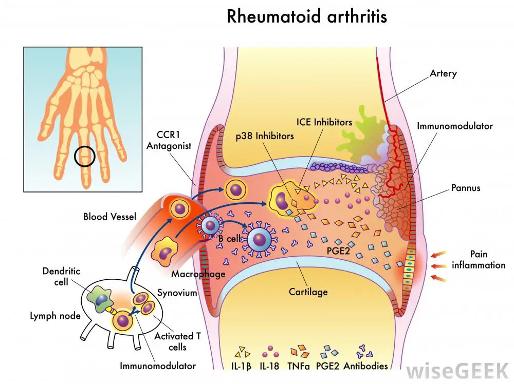 labeled-diagram-of-rheumatoid-arthritis-against-white