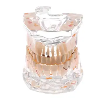 

Dental Implant Disease human Teeth Model Human Mouth Dental Teeth Pathology Anatomical Model