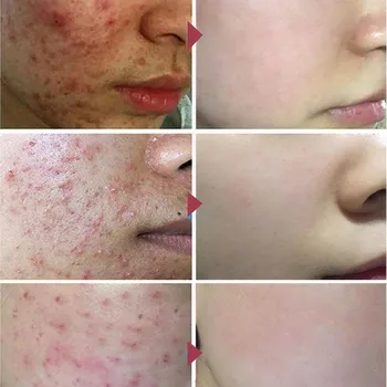 Effective Acne Removal Cream Herbal Acne Spots Oil Control Acne Cream Skin Care Whitening Moisturizing Face Gel Skin Care 20g 2