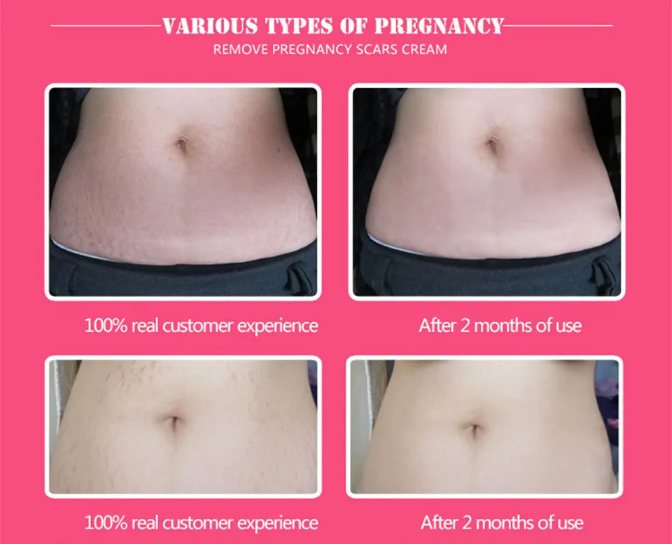 2pcs 100 Oil Bio Active Skin Care Ance Stretch Marks Remover Cream Remove Body Stretch Marks Uneven Skin Tone Purcellin Oil Aliexpress