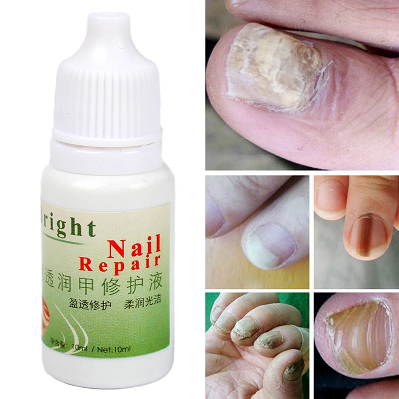 Травяной Антибактериальный раствор для ногтей Лечение онихомикоза стерилизация для удаления грибка для ногтей