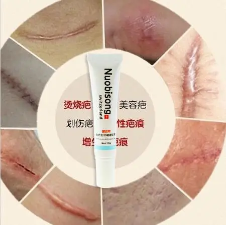 Nuobisong удаление лицевого рубца Striae отображение пигментации корректор