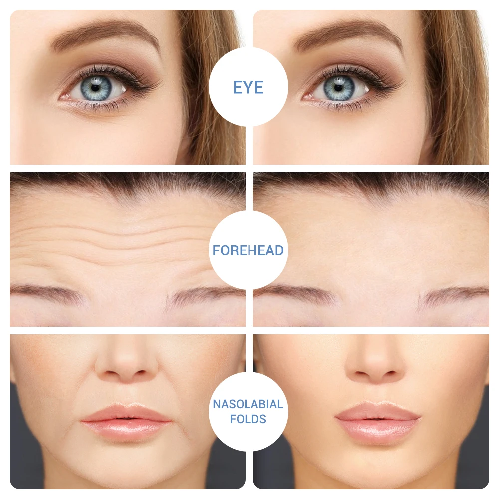 Eye Patches Hyaluronic Acid Micronedle Eye Pad Moisturize Wrinkles Fine Lines Dark Circle Removal Korean Cosmetics Face Mask