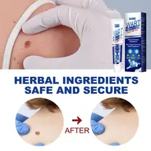 

20g Instant Blemish Removal Gel Wart Removal Body Warts Treatment Cream Foot Care Cream Skin Tag Remover Wart Cream Wholesale