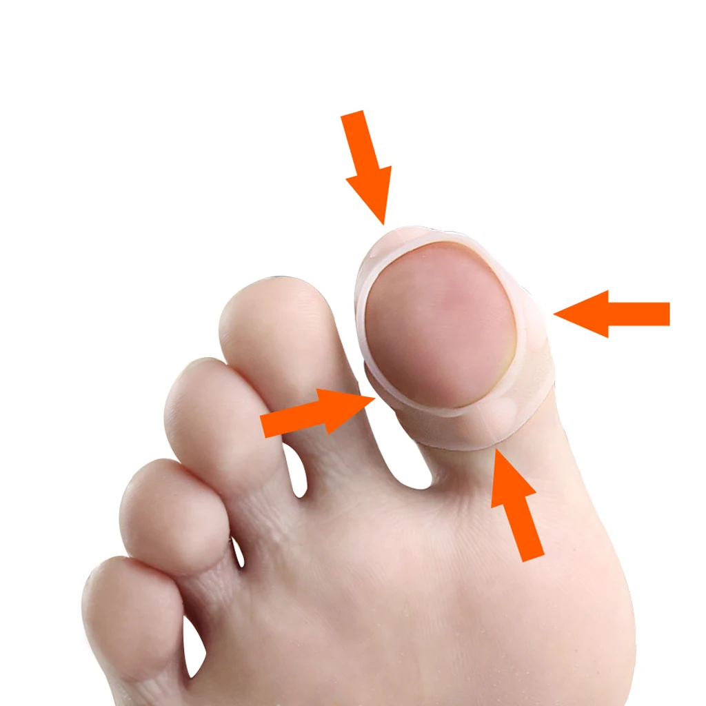 5 пар силиконовых ортодонтических протекторов для вросших ногтей колпачки