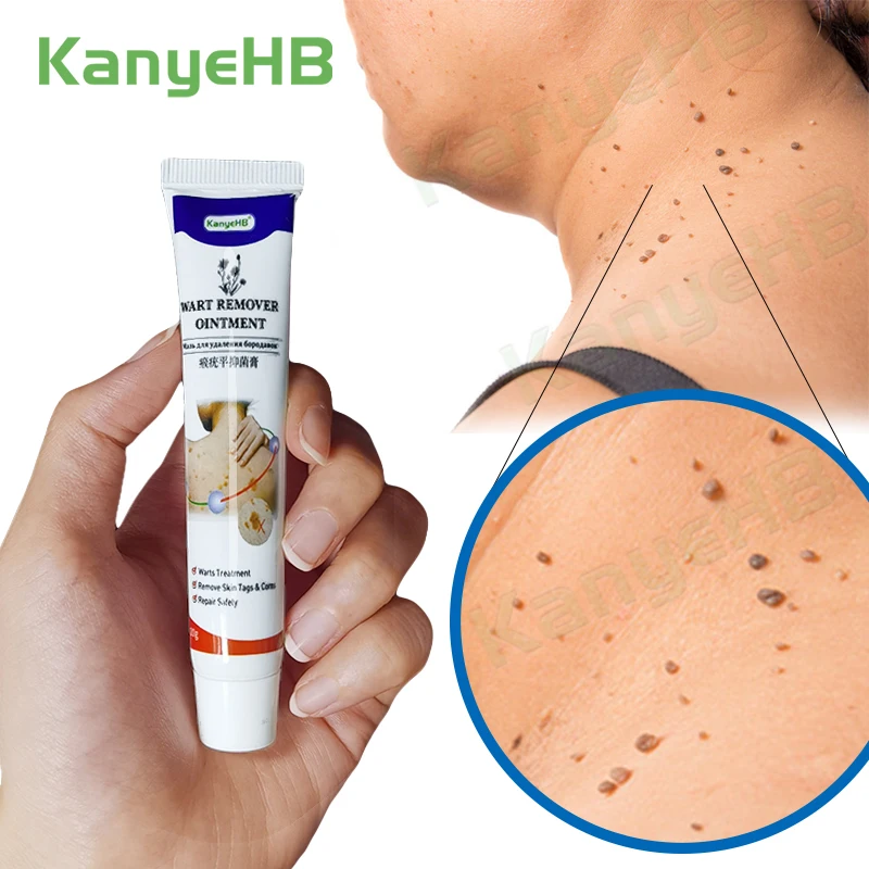 1pcs Wart Removal Ointment Treatment Cream Neck Skin Tag Armpit Flat Genitals Feet Corns Medical G001 | Красота и здоровье