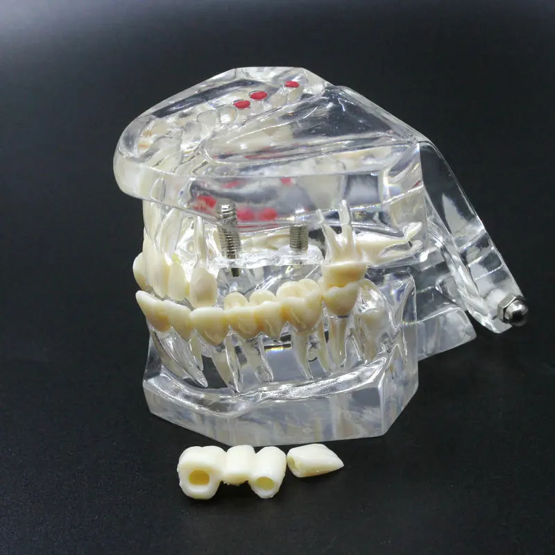 Modelo de Restauração Modelo de Dentes Dentista para a Ciência Laboratório Dental Materila Implante Dentes Ativos Instrumento Médica 4 High Quality Beleza e saúde