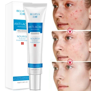 

Acne scar removal acne treatment cream whitening moisturizing gel ointment blemish cream face repair care