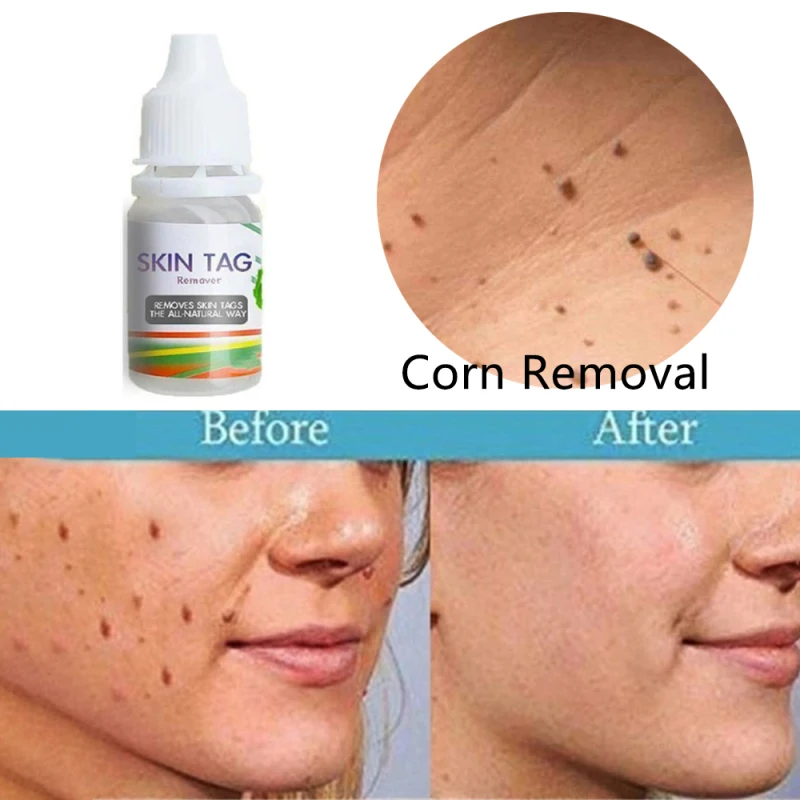 

Chinese Medicine Treatment Skin Warts Removal Foot Corn Removal Plantar warts Pomada De Verruga Skin Care Medical Ointment