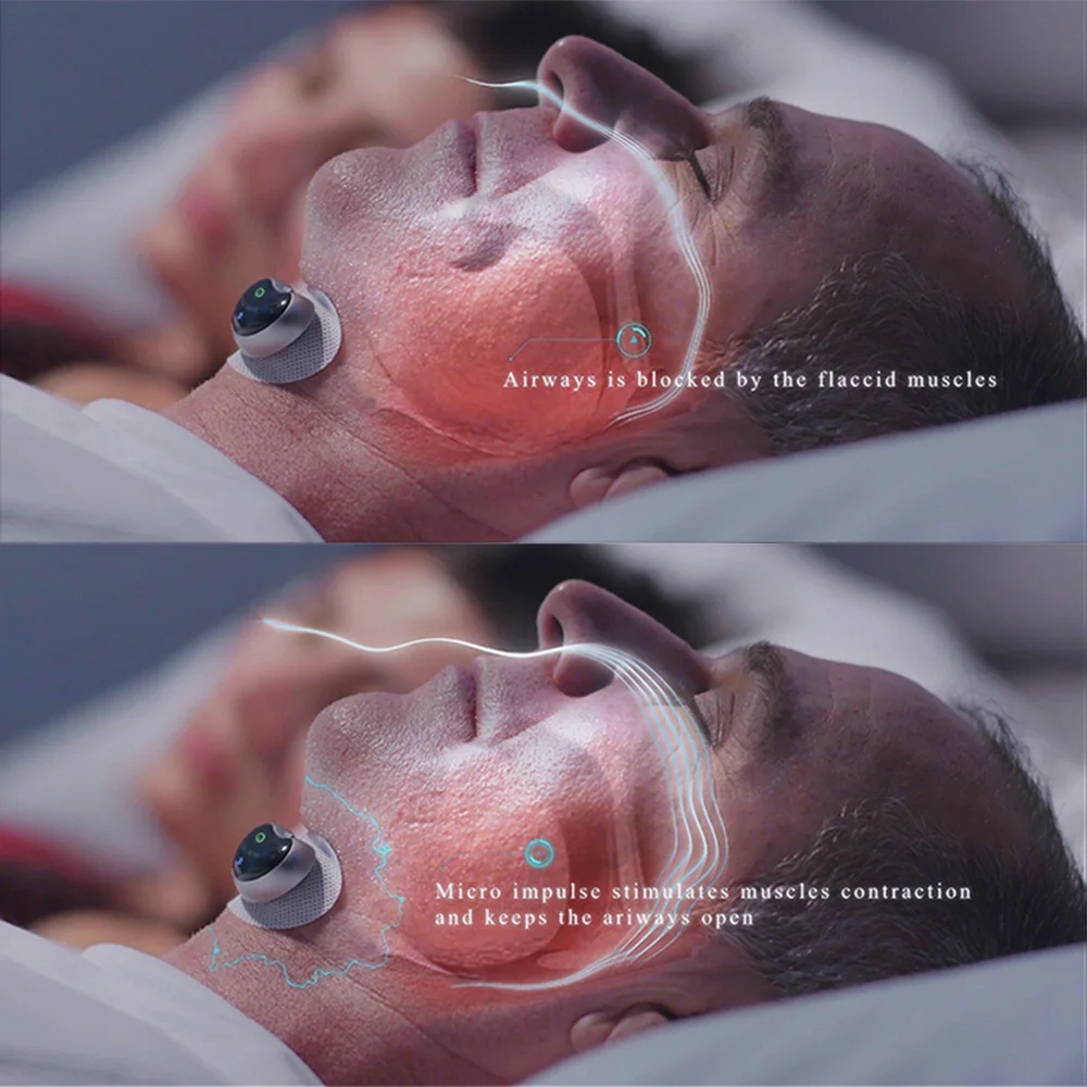 Smart Snore stopper New Generation Assistive Sleep Device Anti-snore Biosensor APP Control Sleep Monitor Improve Sleep Quality