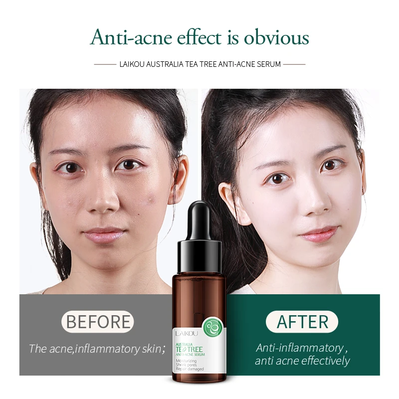 17ml Acne Treatment Serum Natural Australia Tea Tree Extract Essence Anti  Acne Scar Pimple Removal Face Skin Care Products - Face Serum - AliExpress